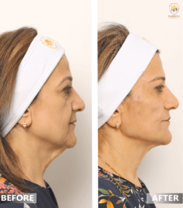 What You Should Do Before and After Cosmetic Surgery